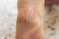 What Causes Cracked Heels?