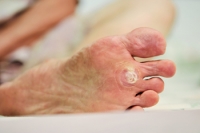 Facts About Plantar Warts